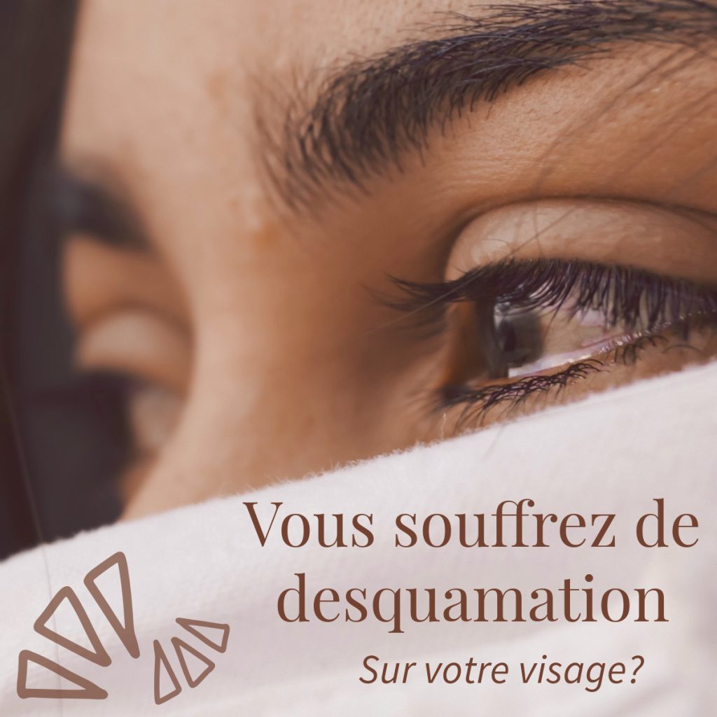 vous souffrez de desquamation?